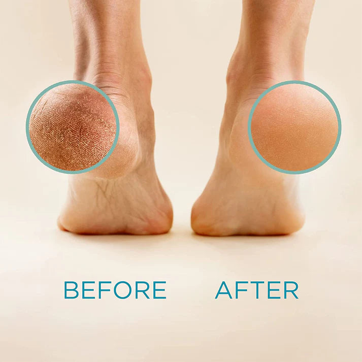 Callus Remover